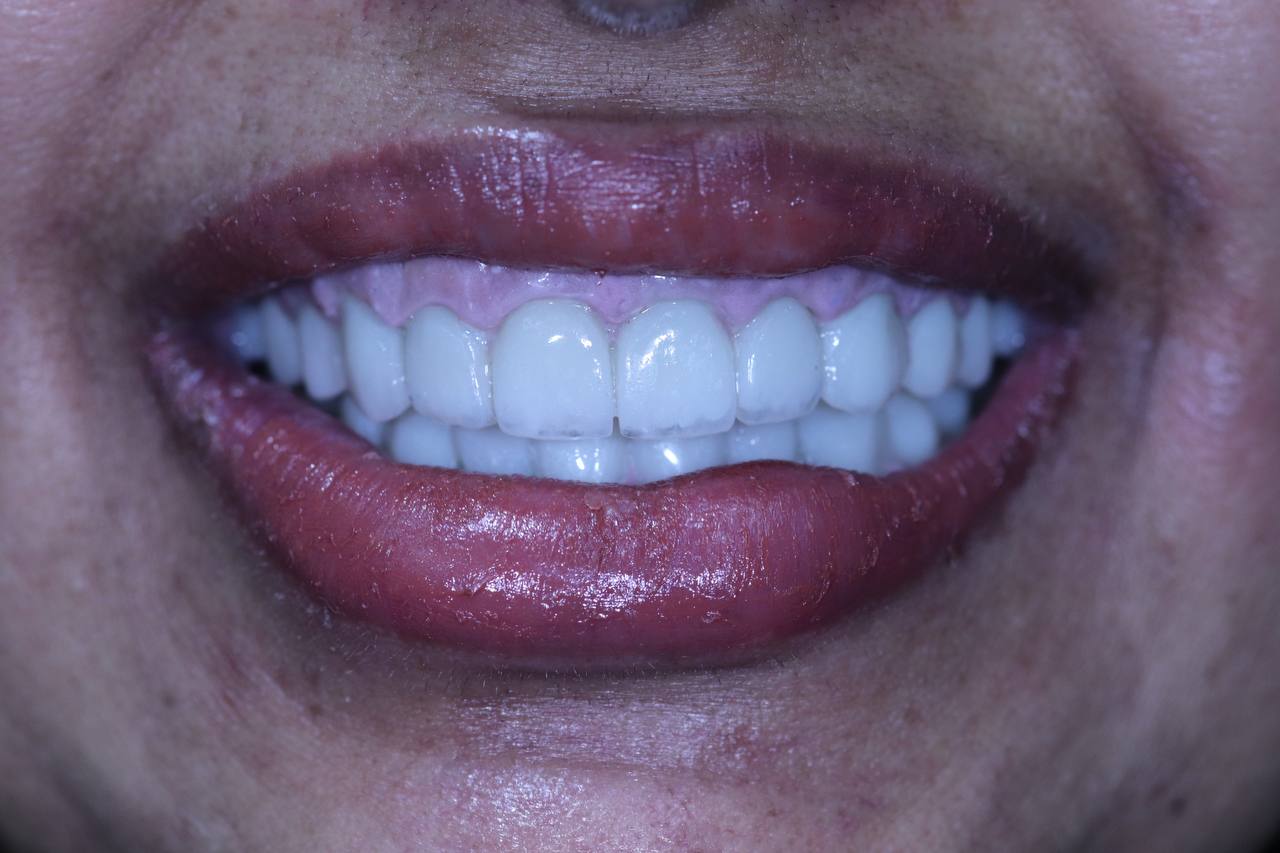 After Image of a dental make over at YOU Maadi Dental CLinic