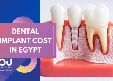 Cost of Dental Implants in Egypt : A Comprehensive Guide