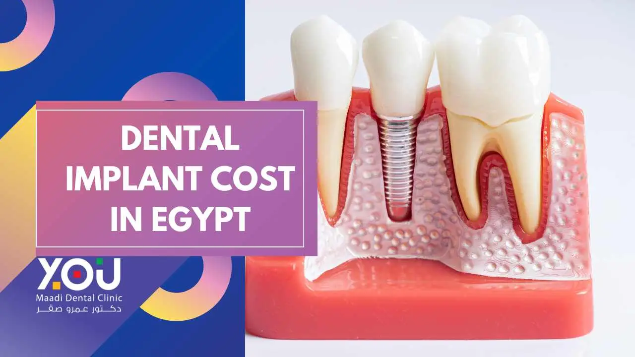 Cost of Dental Implants in Egypt : A Comprehensive Guide
