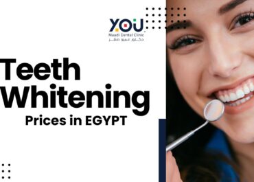 Teeth Whitening Prices in Egypt 2024: Get a dazzling white smile with YOU Clinic