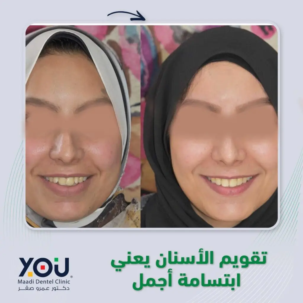 تقويم أسنان قبل وبعد