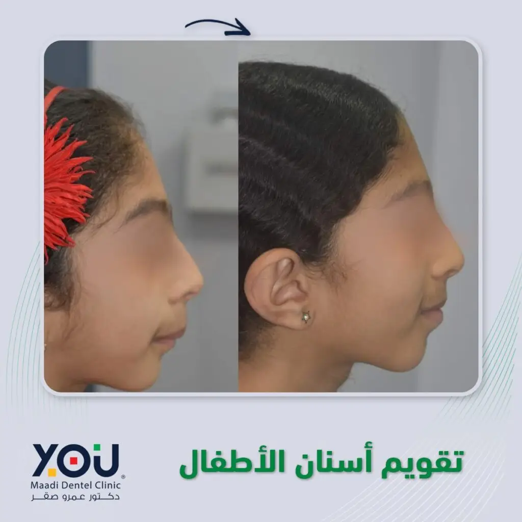 تقويم أسنان قبل وبعد