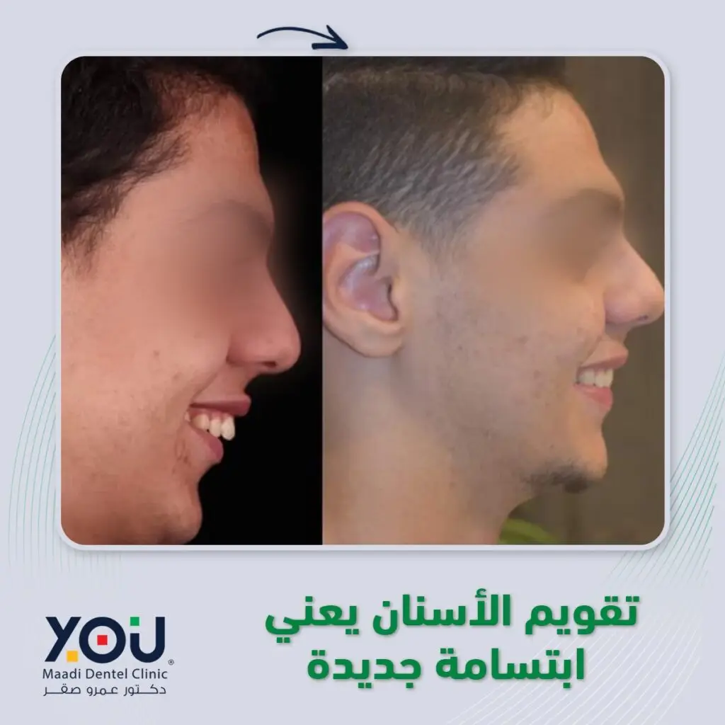 تقويم أسنان قبل وبعد