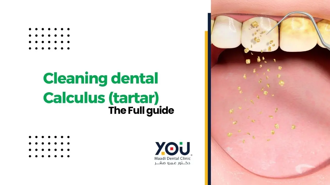 Calculas Cleaning Teeth Scaling Services