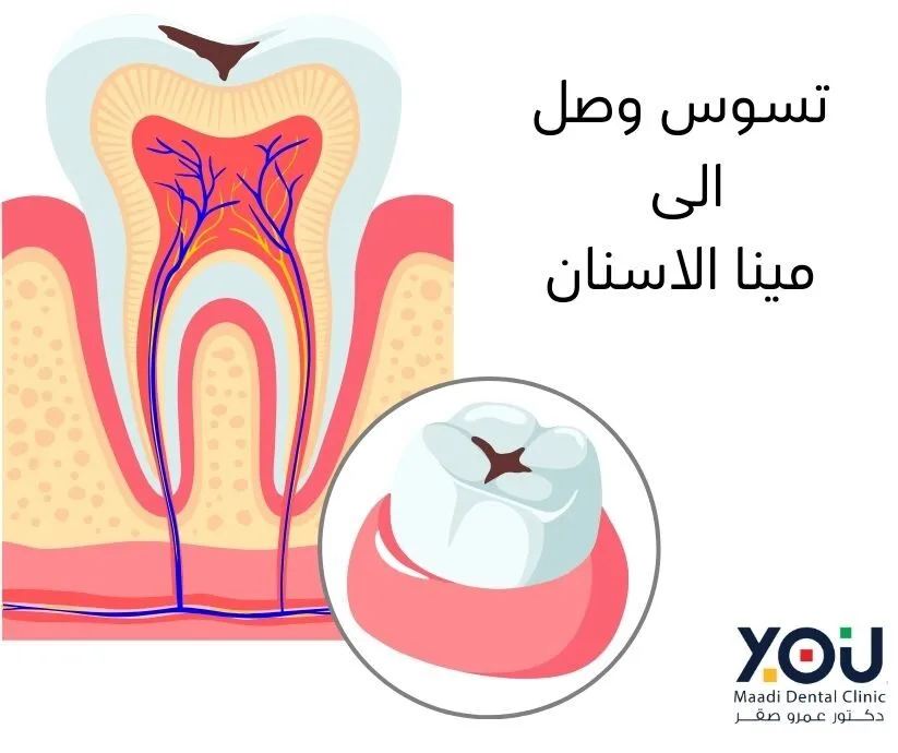 صورة مقربة لسن يظهر بقعة بيضاء باهتة على سطح المينا. 
