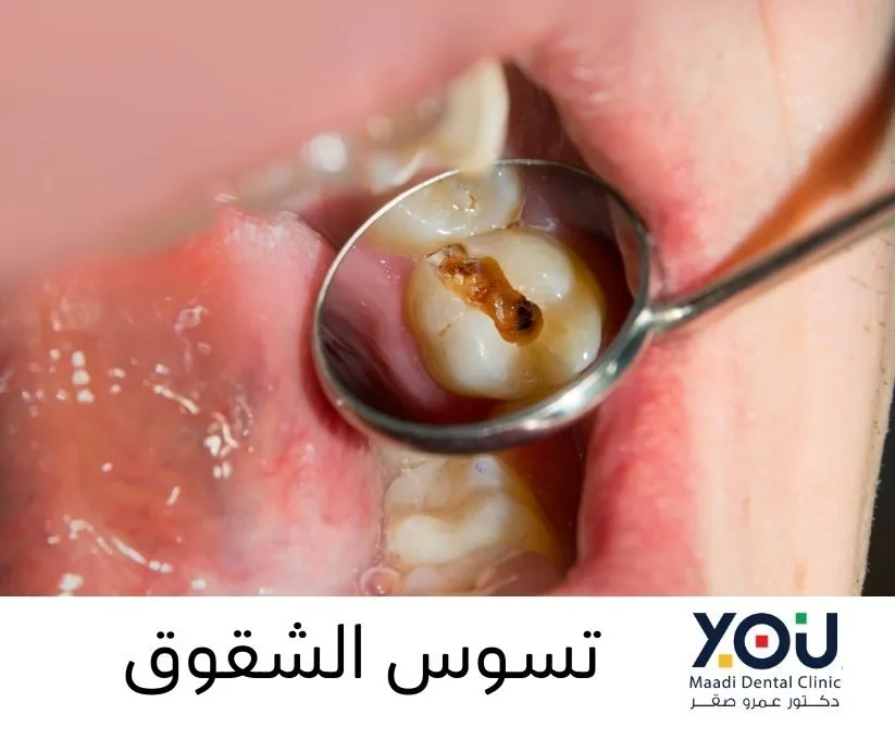 أنواع تسوس الأسنان بالصور