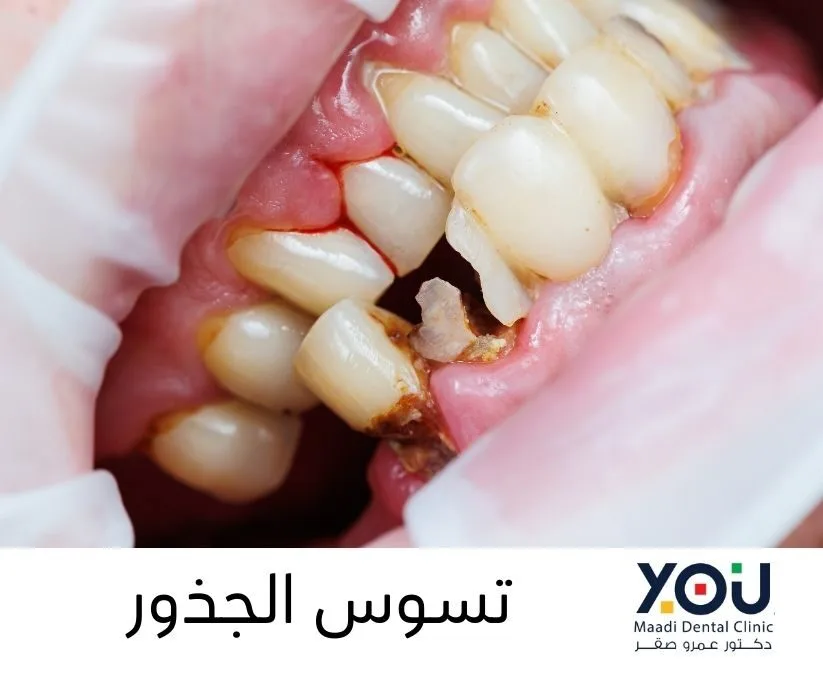 أنواع تسوس الأسنان بالصور