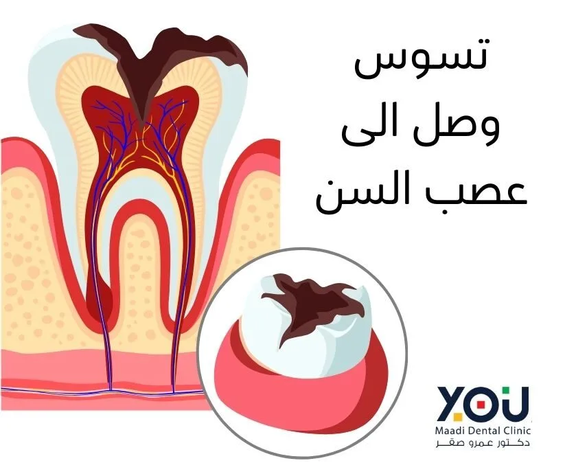 صورة مقربة لسن يظهر تجويفًا عميقًا يصل إلى لب السن الأحمر اللون، مع التهاب في اللثة المحيطة