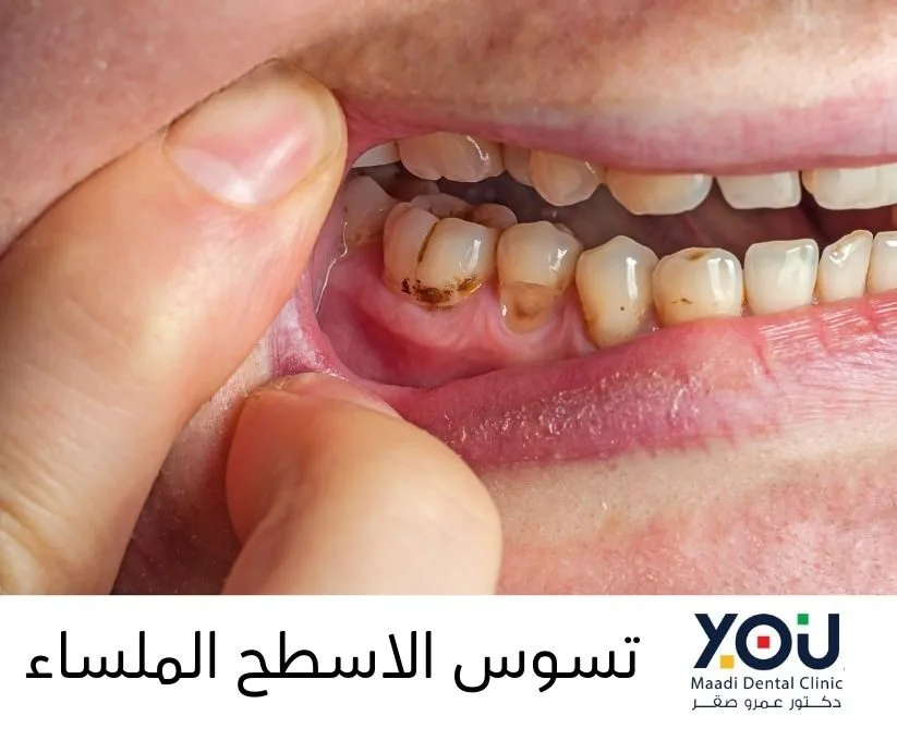أنواع تسوس الأسنان بالصور
