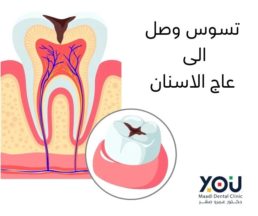 صورة مقربة لسن يظهر تجويفًا صغيرًا يمتد إلى طبقة العاج الصفراء اللون أسفل المينا