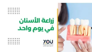 زراعة الأسنان في جلسة واحدة