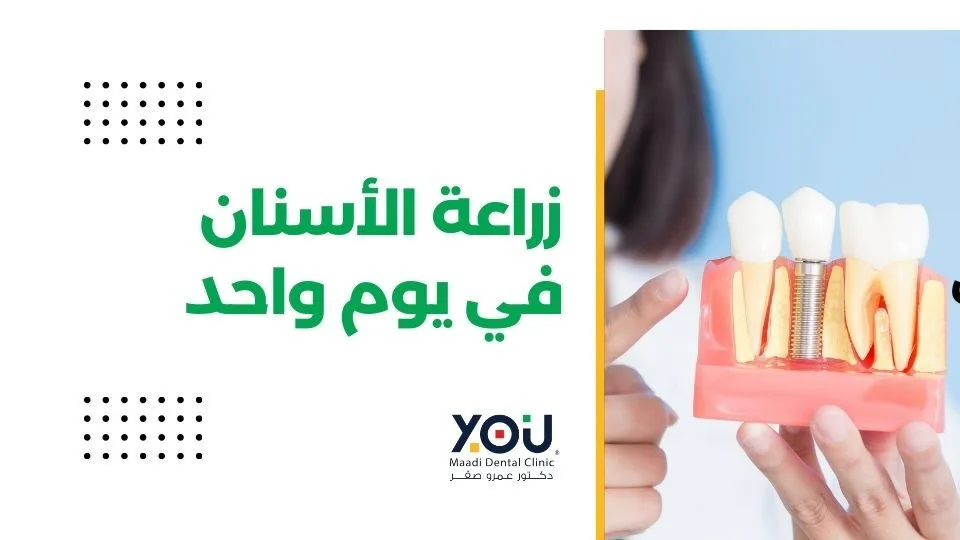 زراعة الاسنان في جلسه واحدة