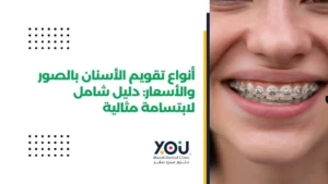 أنواع تقويم الأسنان بالصور واسعارها