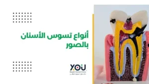 أنواع تسوس الأسنان بالصور