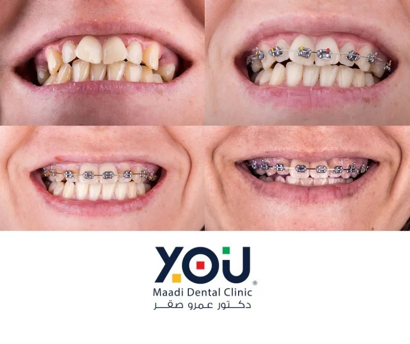 تقويم الاسنان قبل و بعد