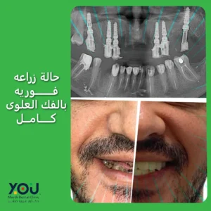 حالة زراعة اسنان فورية