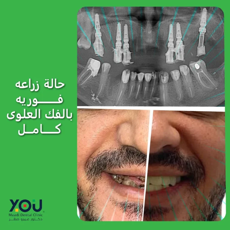 زراعة الاسنان في جلسه واحدة