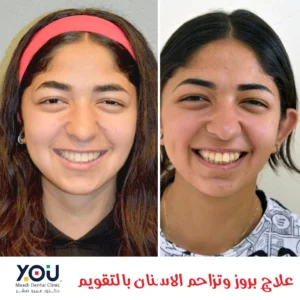 صورة قبل و بعد لحالة تقويم اسنان من خدمات عيادات يو المعادي