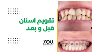تقويم أسنان قبل وبعد
